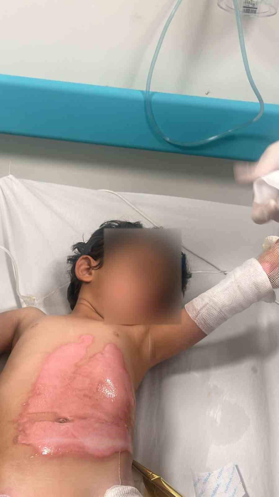 Şırnak’ta 3 yaşındaki kızın üzerine kaynar su döküldü
